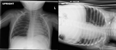 Chest X-Ray with Bronchial Foreign Body